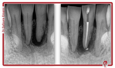 مدیریت دندان با کانال های کلسیفیه شده (Calcified canals)